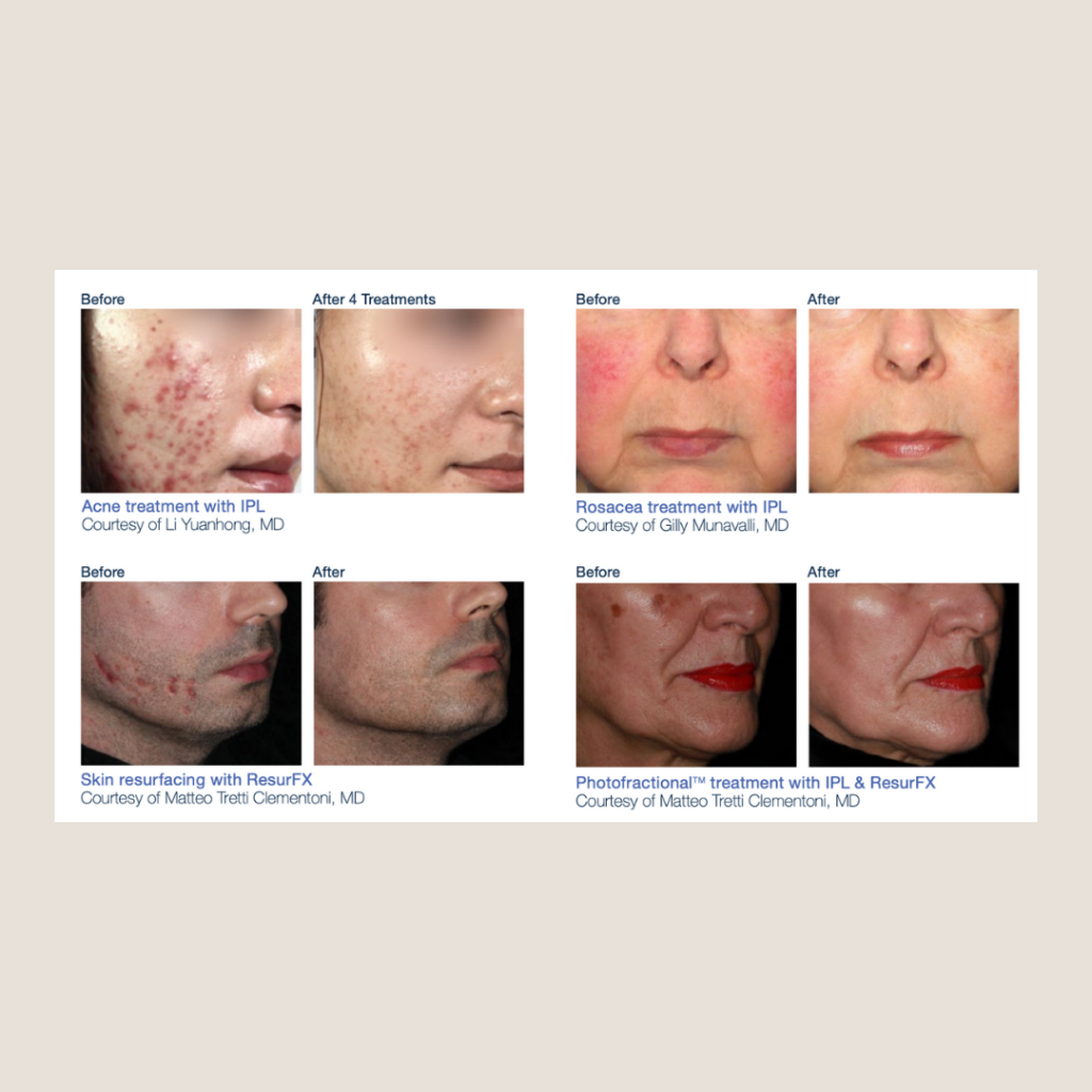 Rosácea Efectos Secundarios Depilacion Luz Pulsada Laser Vascular