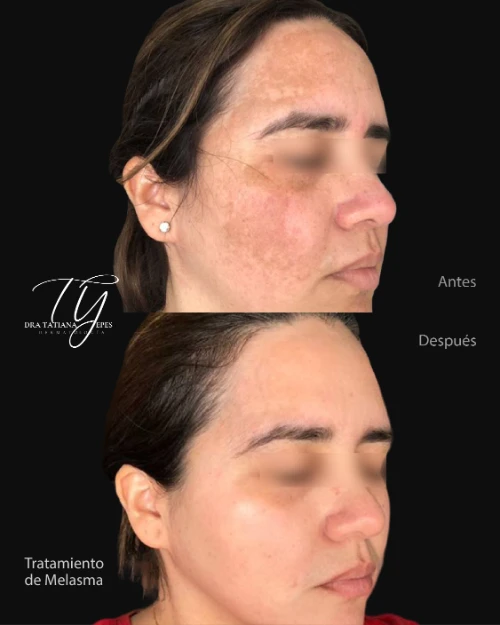Melasma-03